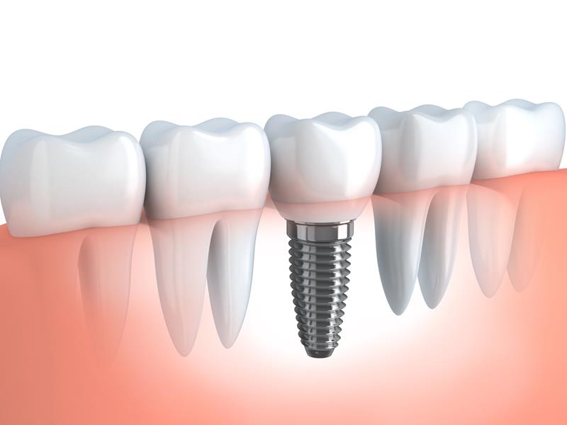 Dental Implants  Pikeville, KY 